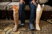 Hussein was amputated following a bombardment and now wears a prosthesis. He explains his difficulties as a disabled person to find a job.