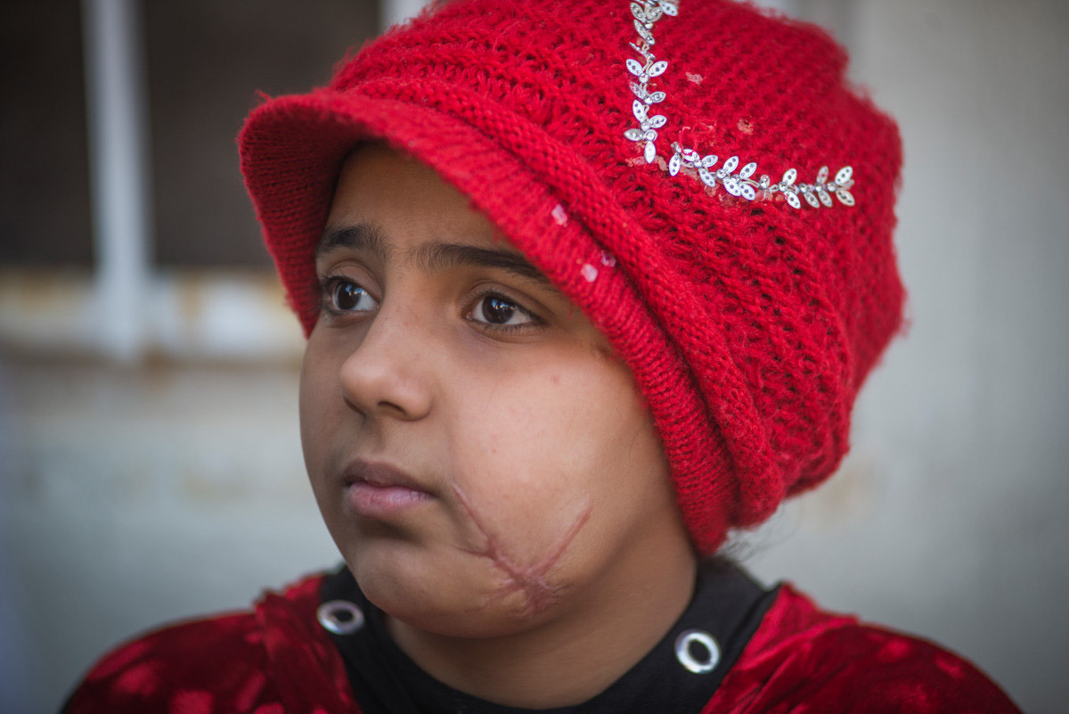 Nada was injured with her father in a bombing in Mosul in April 2017, aged 10 years old
