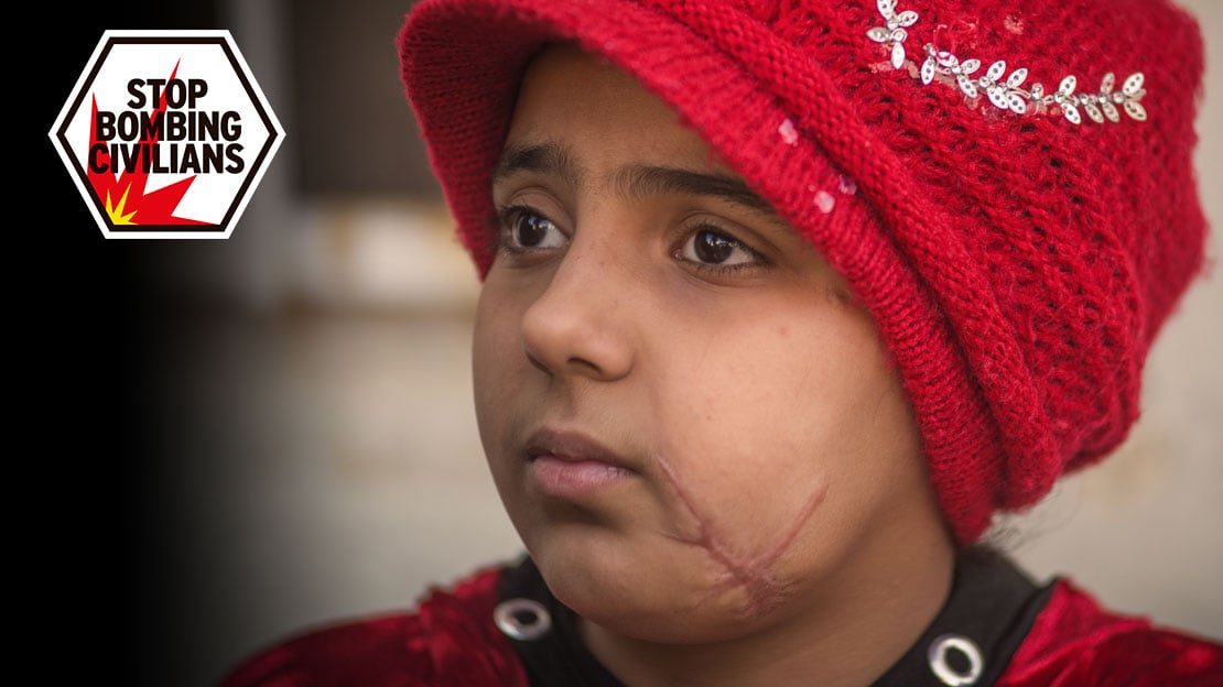 Nada, 10, lost her leg and was badly injured in the chest and face in a bombing in Mosul in April 2017.