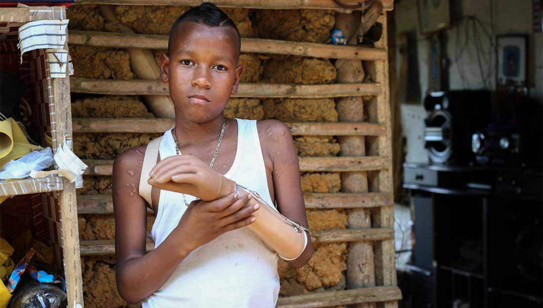 Jemerson, 12, lost his left hand to a landmine left over from the conflict in Colombia. ; }}