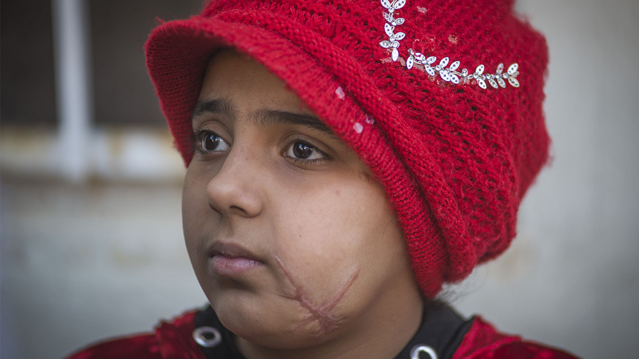 Nada is 10 years old and was injured with her father in a bombing in Mosul, in April 2017.; }}