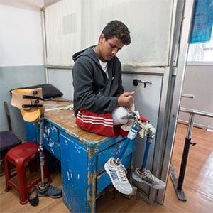 Ramesh fitting his prosthetic legs